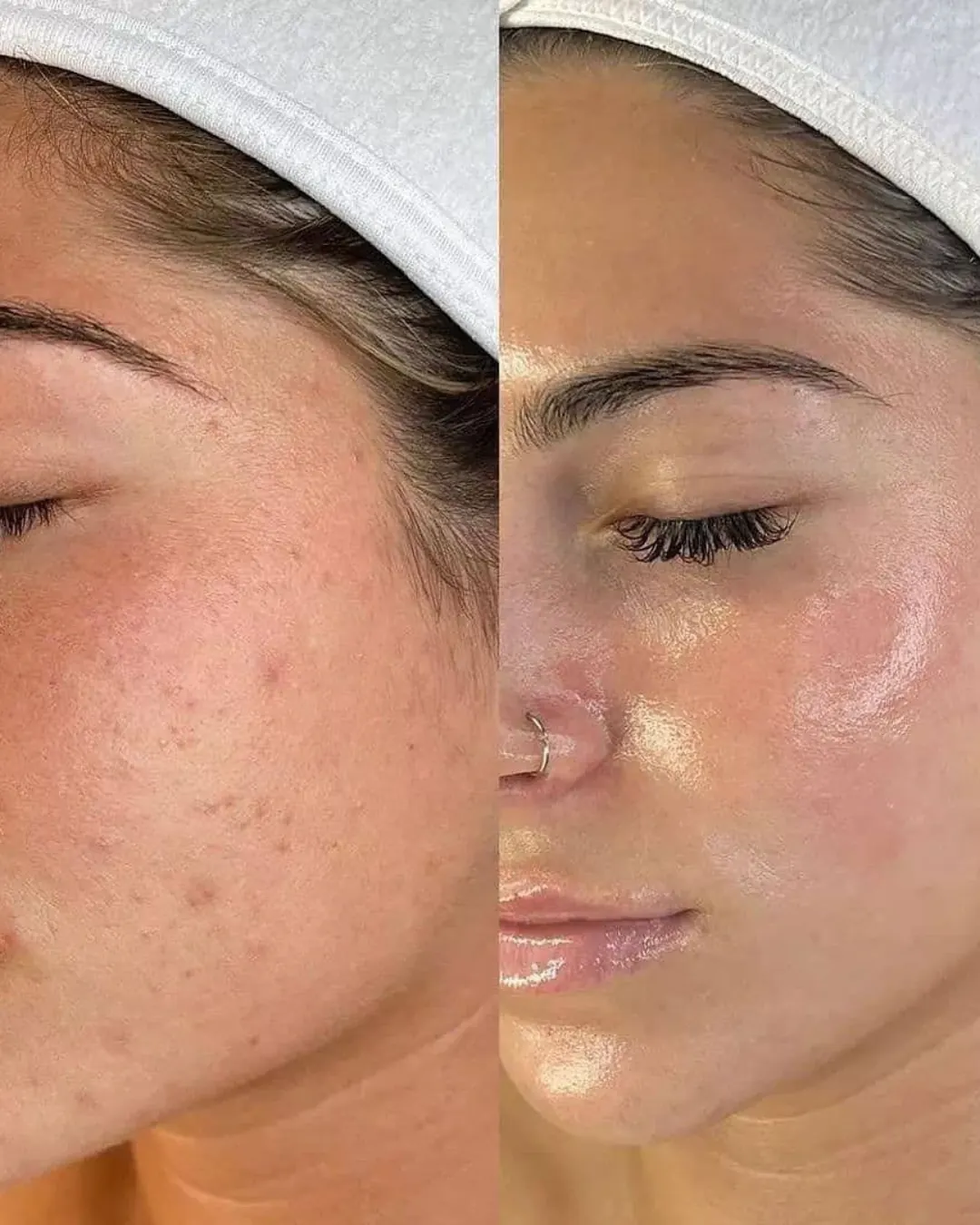 Before and After PDRN Microneedling in Calgary