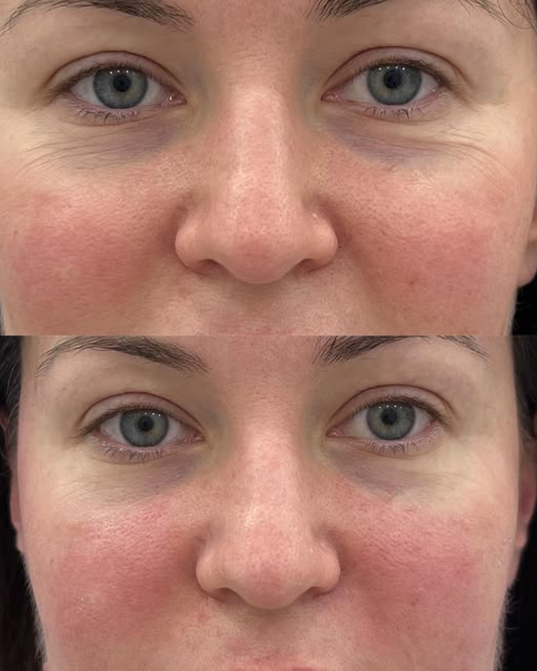 Before and After Exo NAD+ Microneedling in Calgary