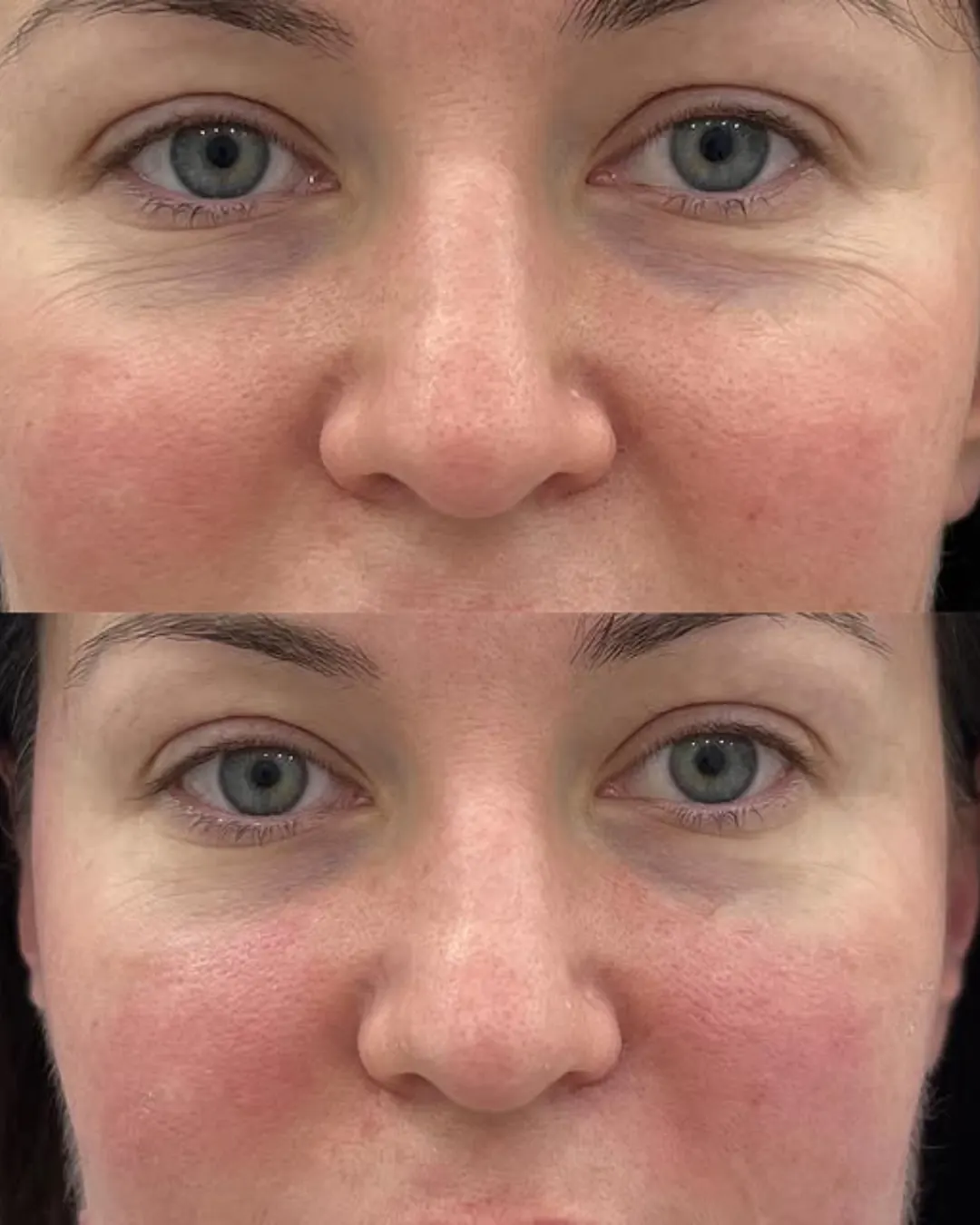 Before and After Exo NAD+ Microneedling in Calgary